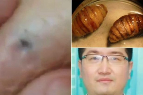 Man’s Horror As 20 Live Maggots Are Found Living Under His Skin After Trip To Africa